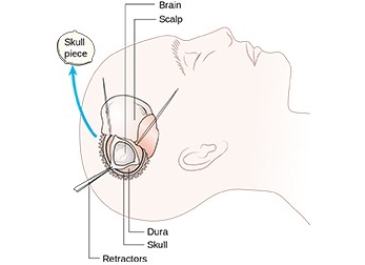 Craniotomy