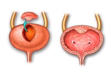 Cystectomy