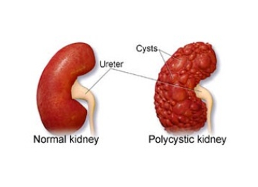 Cyst Unroofing or Decortication