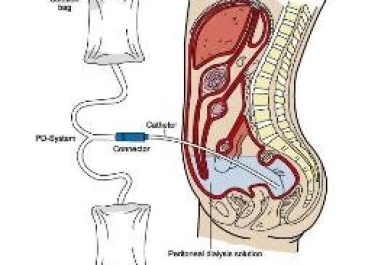 Peritoneal Dialysis (PD)