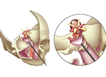 Minimally Invasive Endonasal Endoscopic Surgery