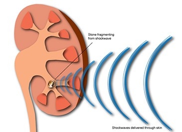 Extracorporeal Shock Wave Lithotripsy (ESWL or Lithotripsy)