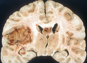 Glioma Brain Tumors