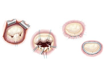 Heart Valve Repair Surgery