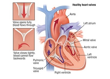 Heart Valve Replacement