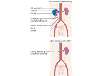 Kidney Removal (Nephrectomy)