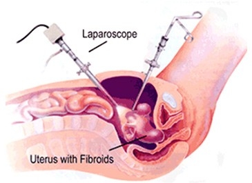 Laparoscopic Myomectomy