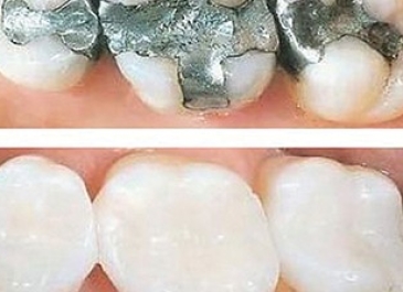 Laser Fillings