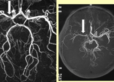 Moyamoya Disease