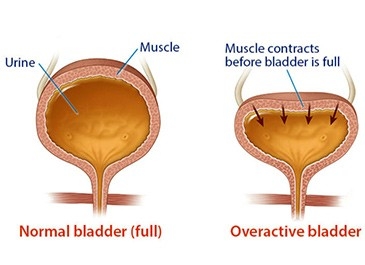 Overactive Bladder