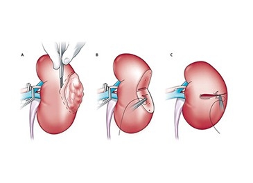 Partial Nephrectomy