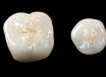 Porcelain Crowns