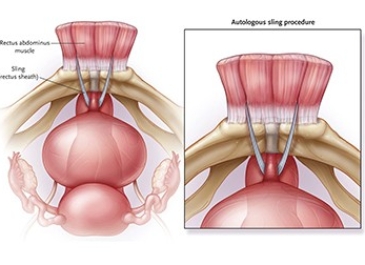 Retropubic Suspension