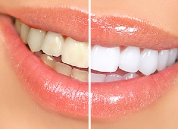 Teeth Bleaching