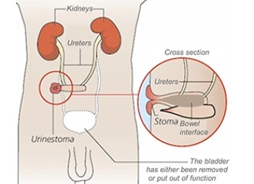 Total Cystectomy