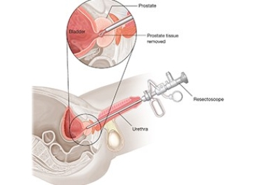 Transurethral Resecion