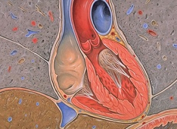 Tricuspid Valve Repair