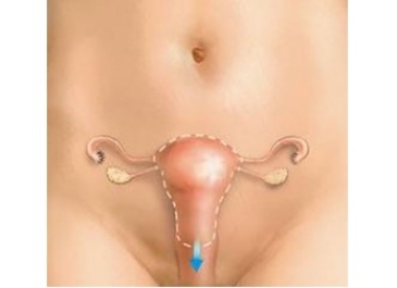 Vaginal Hysterectomy