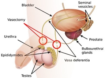 Vasectomy